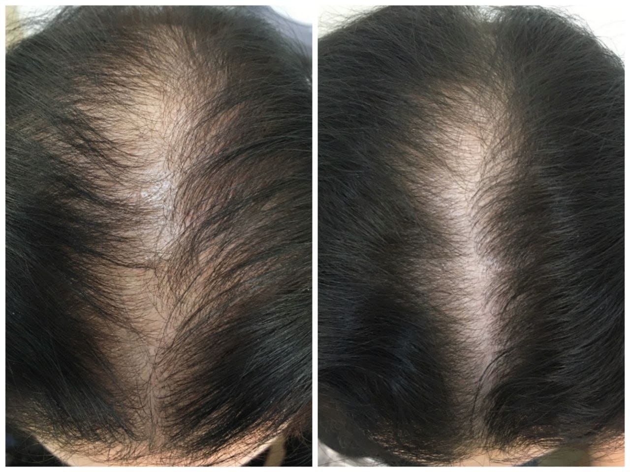 Врач-трихолог в Минске лечение волос до/после